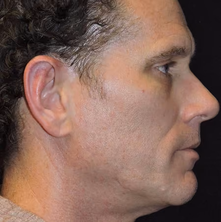Ear Reshaping before and after, case 2177 - Cool Springs Plastic Surgery