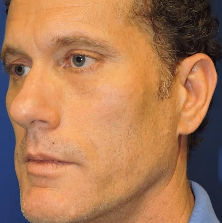 Ear Reshaping before and after, case 2177 - Cool Springs Plastic Surgery