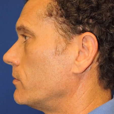 Ear Reshaping before and after, case 2177 - Cool Springs Plastic Surgery