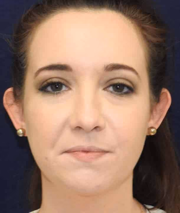 Ear Reshaping before and after, case 2417 - Cool Springs Plastic Surgery