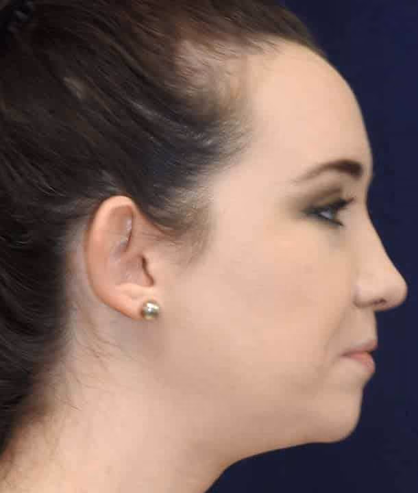 Ear Reshaping before and after, case 2417 - Cool Springs Plastic Surgery