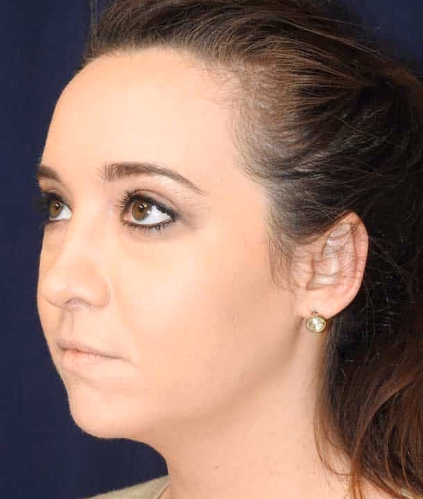Ear Reshaping before and after, case 2417 - Cool Springs Plastic Surgery