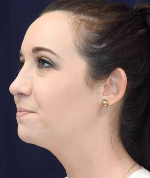 Ear Reshaping before and after, case 2417 - Cool Springs Plastic Surgery