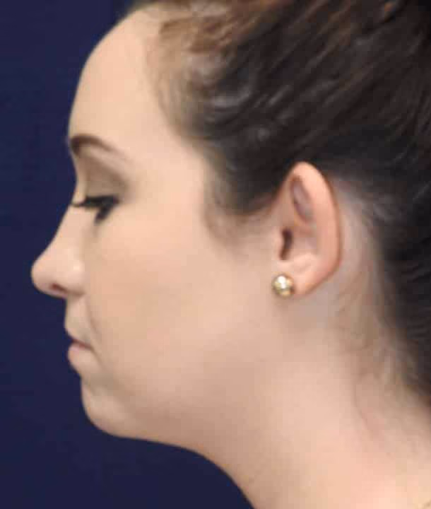 Ear Reshaping before and after, case 2417 - Cool Springs Plastic Surgery