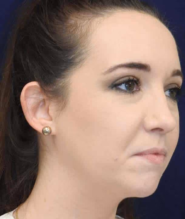 Ear Reshaping before and after, case 2417 - Cool Springs Plastic Surgery