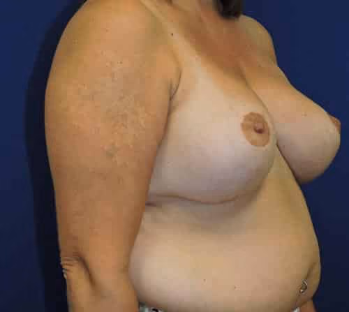 Breast Reduction before and after, case 2753 - Cool Springs Plastic Surgery