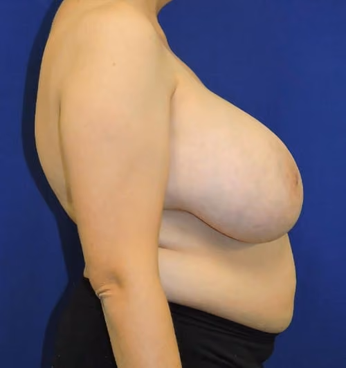 Breast Reduction before and after, case 2953 - Cool Springs Plastic Surgery