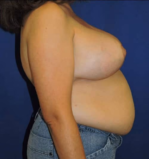 Breast Reduction before and after, case 2953 - Cool Springs Plastic Surgery