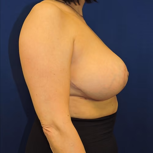 Breast Reduction before and after, case 3173 - Cool Springs Plastic Surgery