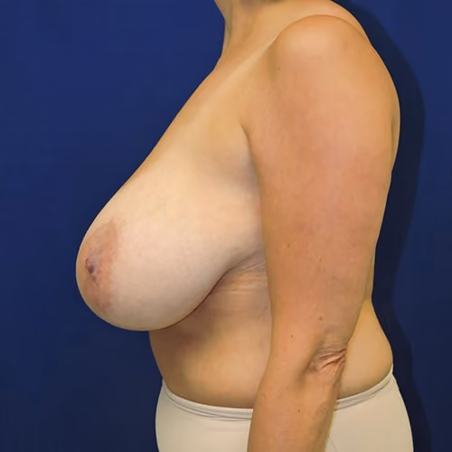 Breast Reduction before and after, case 3173 - Cool Springs Plastic Surgery