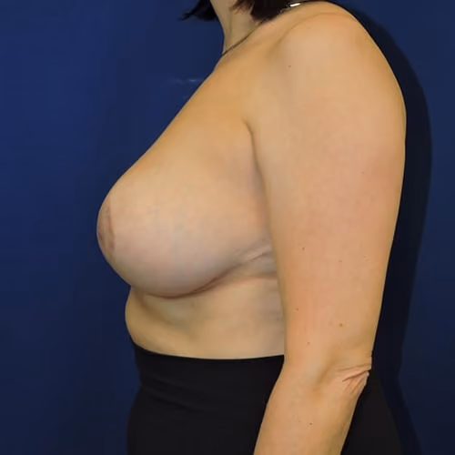 Breast Reduction before and after, case 3173 - Cool Springs Plastic Surgery