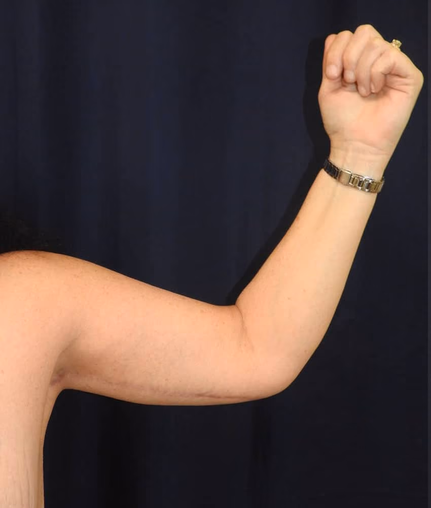 Arm Lift / Brachioplasty before and after, case 6260 - Cool Springs Plastic Surgery