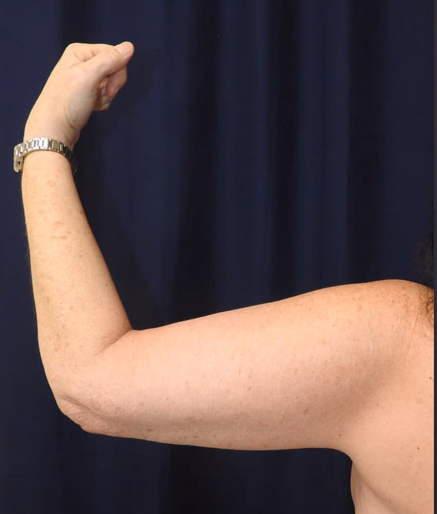 Arm Lift / Brachioplasty before and after, case 6260 - Cool Springs Plastic Surgery