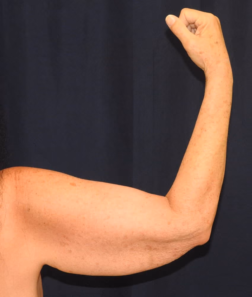 Arm Lift / Brachioplasty before and after, case 6260 - Cool Springs Plastic Surgery