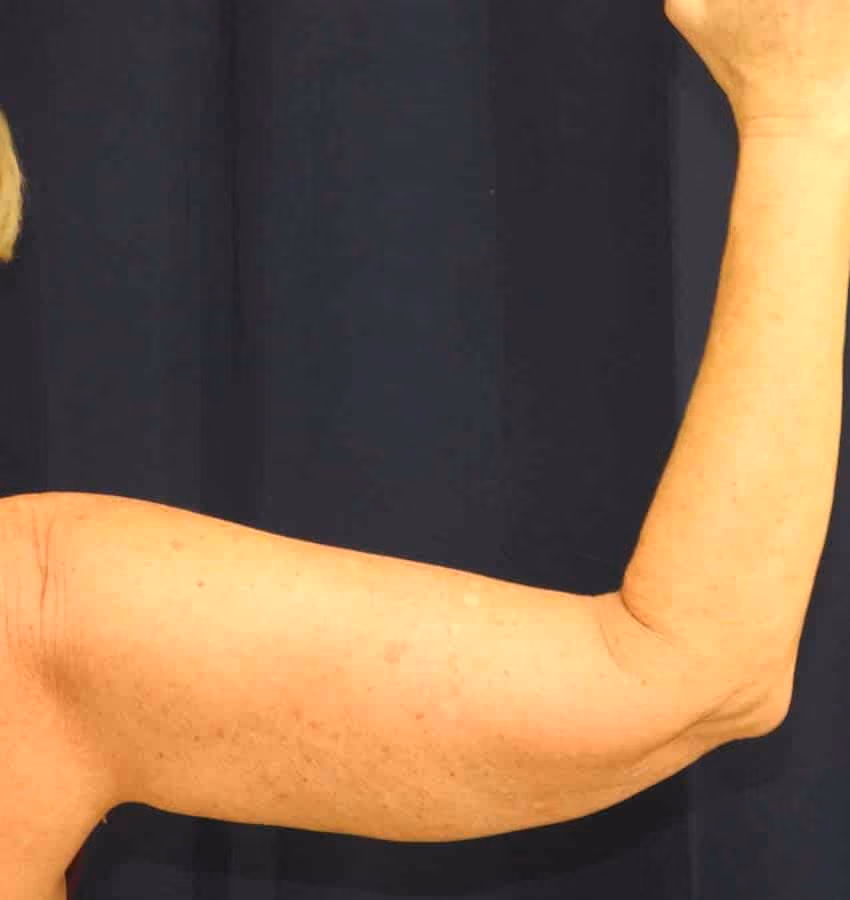 Arm Lift / Brachioplasty before and after, case 6416 - Cool Springs Plastic Surgery