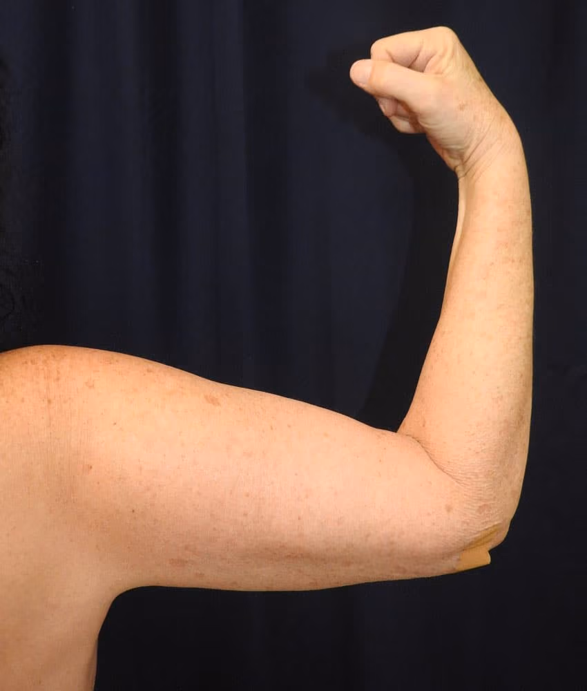 Arm Lift / Brachioplasty before and after, case 6260 - Cool Springs Plastic Surgery