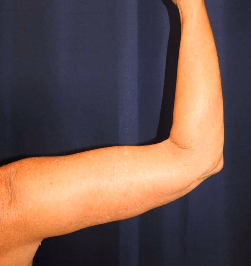 Arm Lift / Brachioplasty before and after, case 6416 - Cool Springs Plastic Surgery