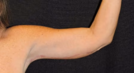 Arm Lift / Brachioplasty before and after, case 6506 - Cool Springs Plastic Surgery