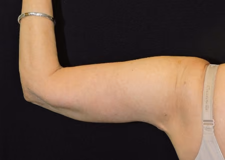 Arm Lift / Brachioplasty before and after, case 6684 - Cool Springs Plastic Surgery