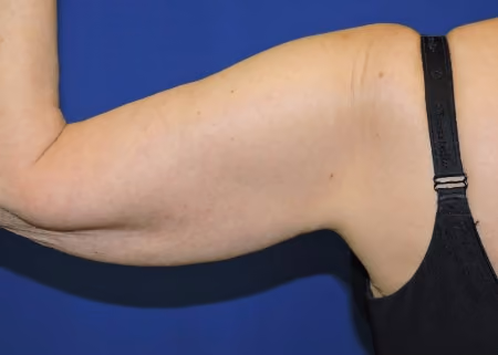 Arm Lift / Brachioplasty before and after, case 6684 - Cool Springs Plastic Surgery