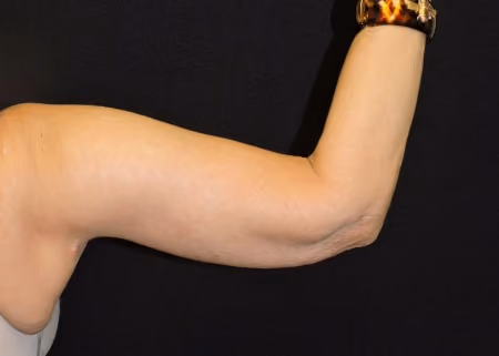 Arm Lift / Brachioplasty before and after, case 6684 - Cool Springs Plastic Surgery