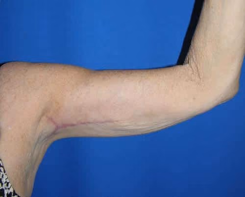 Arm Lift / Brachioplasty before and after, case 6968 - Cool Springs Plastic Surgery