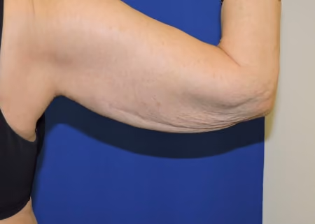 Arm Lift / Brachioplasty before and after, case 6684 - Cool Springs Plastic Surgery