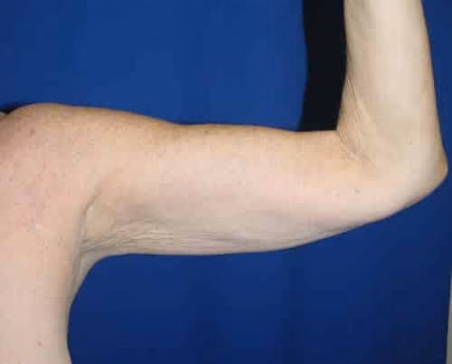 Arm Lift / Brachioplasty before and after, case 6968 - Cool Springs Plastic Surgery
