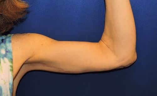 Arm Lift / Brachioplasty before and after, case 7060 - Cool Springs Plastic Surgery