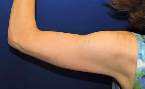 Arm Lift / Brachioplasty before and after, case 7060 - Cool Springs Plastic Surgery