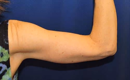 Arm Lift / Brachioplasty before and after, case 7060 - Cool Springs Plastic Surgery