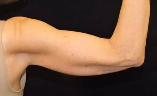 Arm Lift / Brachioplasty before and after, case 7060 - Cool Springs Plastic Surgery