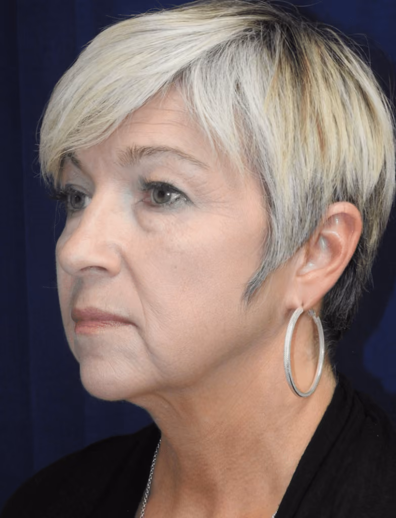 Eyelid Surgery before and after, case 1632 - Cool Springs Plastic Surgery