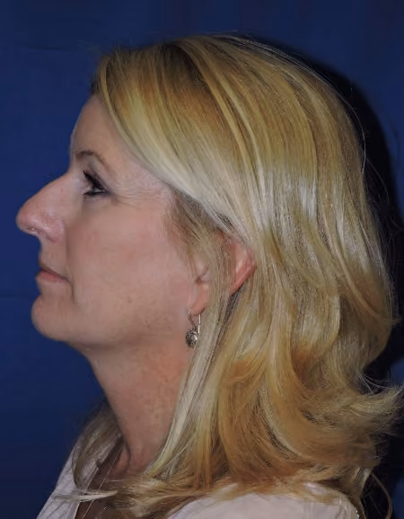 Eyelid Surgery before and after, case 1807 - Cool Springs Plastic Surgery