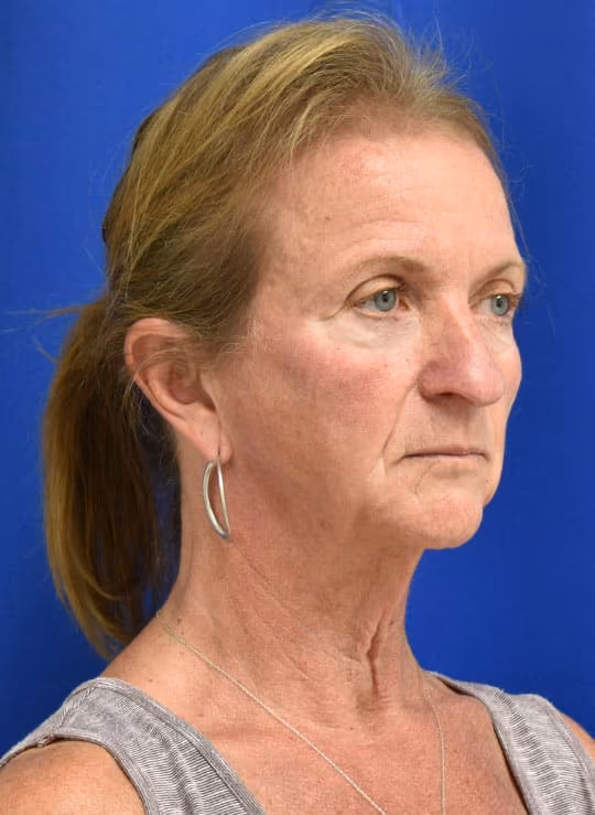 Facial Fat Grafting before and after, case 1705 - Cool Springs Plastic Surgery