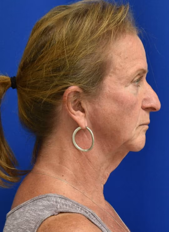 Facial Fat Grafting before and after, case 1705 - Cool Springs Plastic Surgery