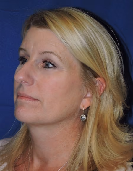 Eyelid Surgery before and after, case 1807 - Cool Springs Plastic Surgery
