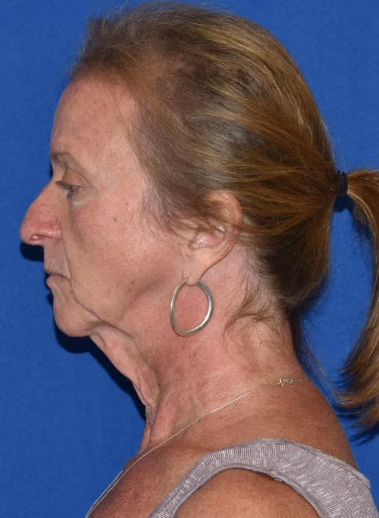 Facial Fat Grafting before and after, case 1705 - Cool Springs Plastic Surgery