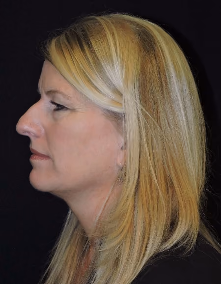 Eyelid Surgery before and after, case 1807 - Cool Springs Plastic Surgery