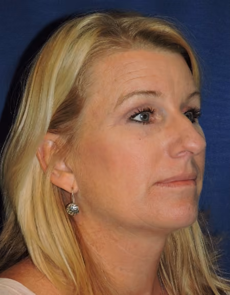 Eyelid Surgery before and after, case 1807 - Cool Springs Plastic Surgery