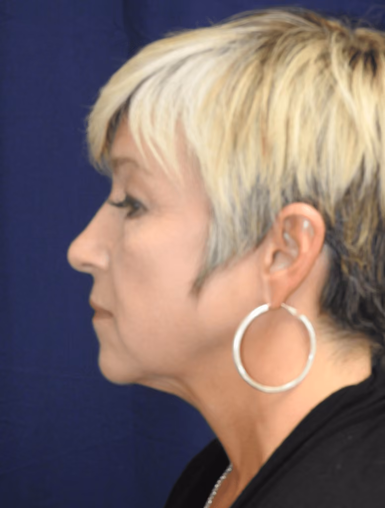 Eyelid Surgery before and after, case 1632 - Cool Springs Plastic Surgery
