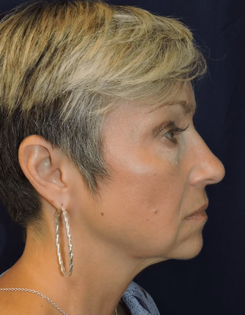 Eyelid Surgery before and after, case 1632 - Cool Springs Plastic Surgery
