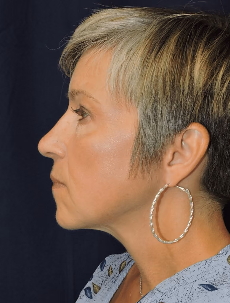 Eyelid Surgery before and after, case 1632 - Cool Springs Plastic Surgery