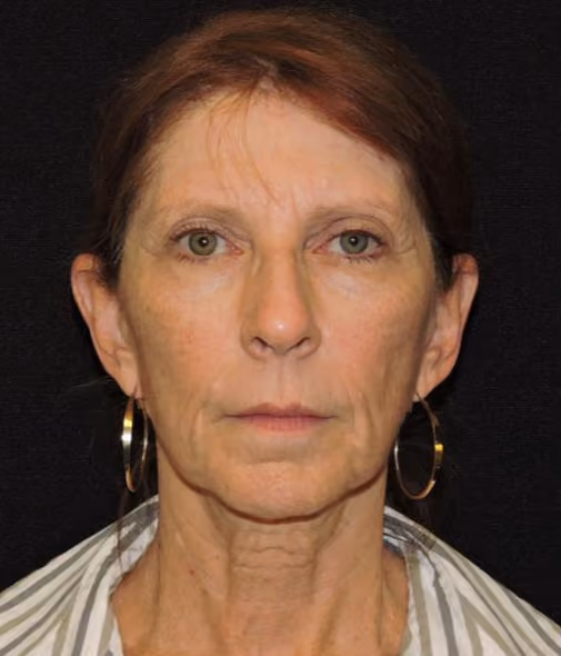 Facial Fat Grafting before and after, case 1979 - Cool Springs Plastic Surgery