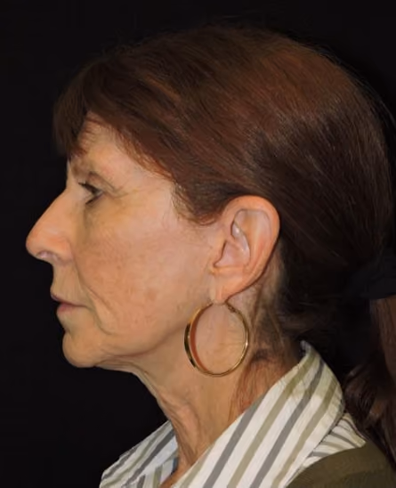 Facial Fat Grafting before and after, case 1979 - Cool Springs Plastic Surgery