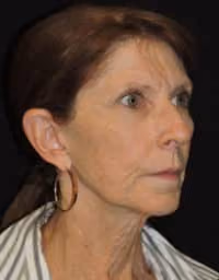 Facial Fat Grafting before and after, case 1979 - Cool Springs Plastic Surgery