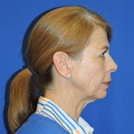 Facial Fat Grafting before and after, case 2054 - Cool Springs Plastic Surgery
