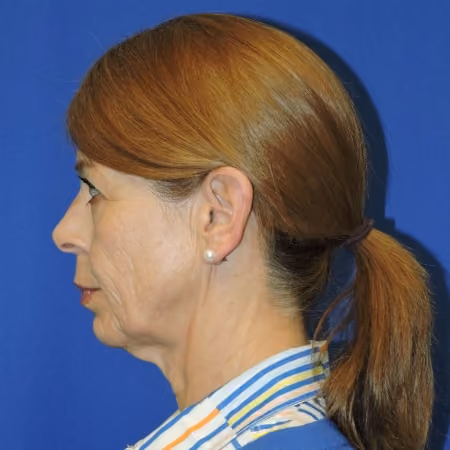 Facial Fat Grafting before and after, case 2054 - Cool Springs Plastic Surgery