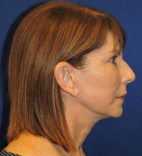 Facial Fat Grafting before and after, case 1979 - Cool Springs Plastic Surgery
