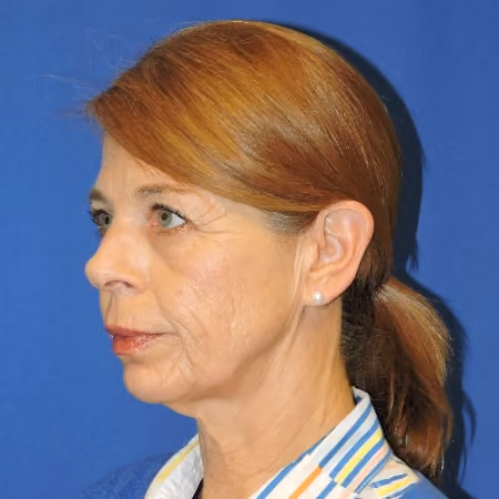 Facial Fat Grafting before and after, case 2054 - Cool Springs Plastic Surgery